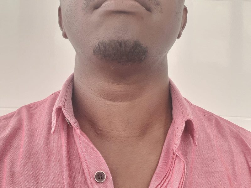 Case 1 — Male patient — after RFA (shared with written consent)