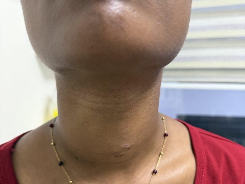 Case 2 — Female patient — after RFA (shared with written consent)