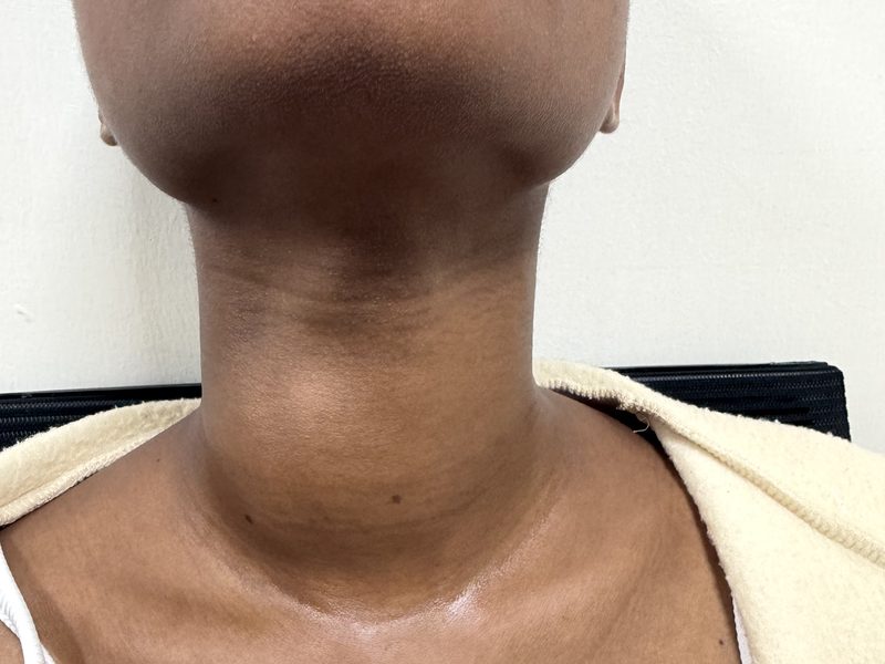 Case 2 — Female patient — before RFA (shared with written consent)