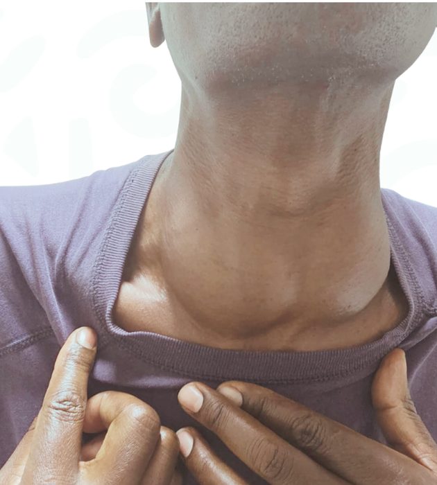 Model photo — patient with a visible thyroid nodule at the front of the neck