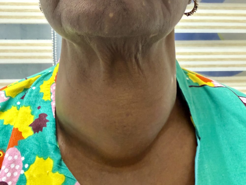 Patient with a visible goitre at the front of the neck — shared with written consent