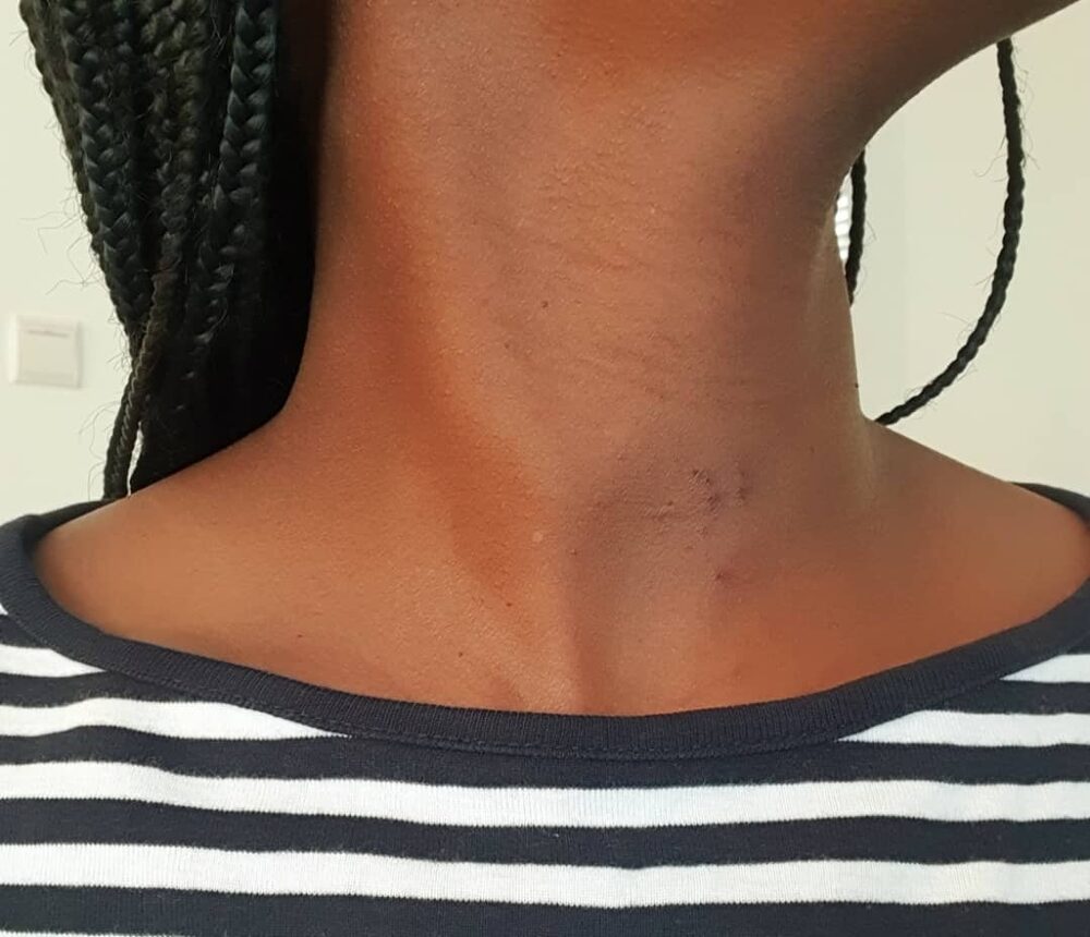 One month after RFA — the neck swelling continuing to settle (shared with written consent)