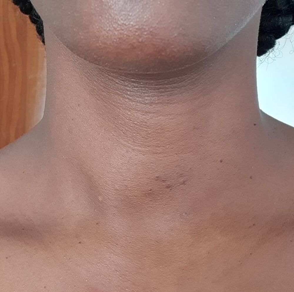 Two months after RFA — the neck swelling almost completely flat (shared with written consent)