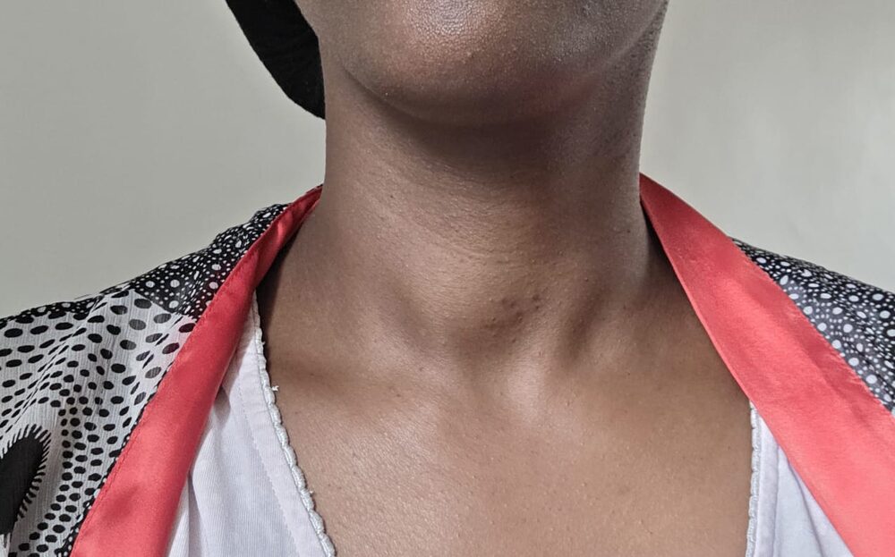 Two weeks after RFA — the neck swelling already visibly reduced (shared with written consent)