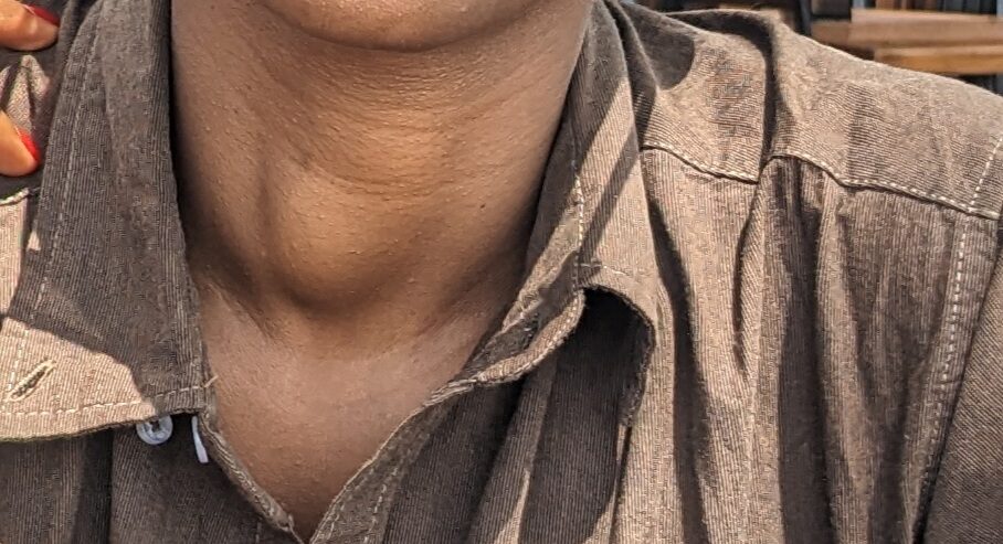 Before RFA — a visible swelling from a toxic thyroid nodule (shared with written consent)