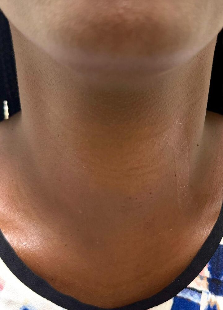 The day of radiofrequency ablation treatment in Nairobi for a toxic thyroid nodule (shared with written consent)