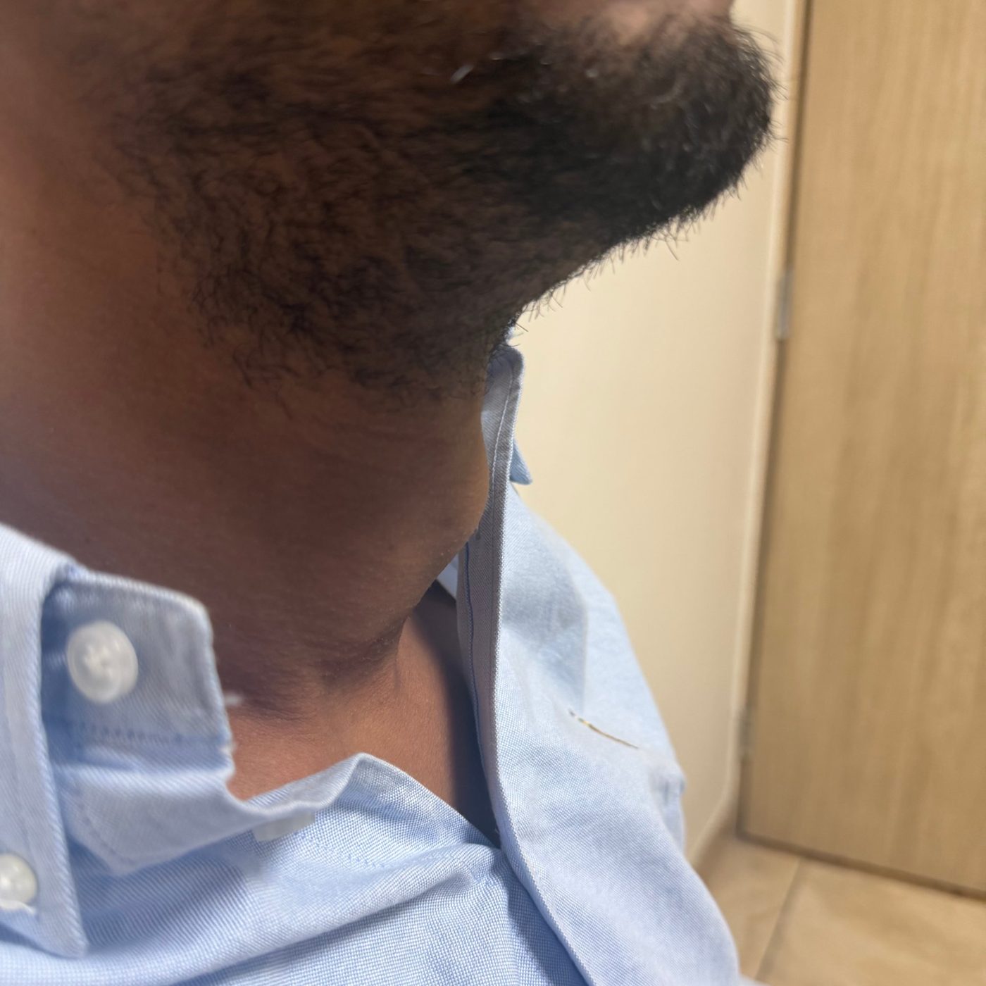 Side view of the neck before treatment showing the goitre swelling below the jaw (anonymised; shared with written consent)
